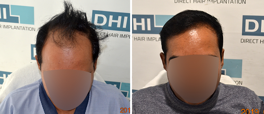 DHI before & after hair transplant results